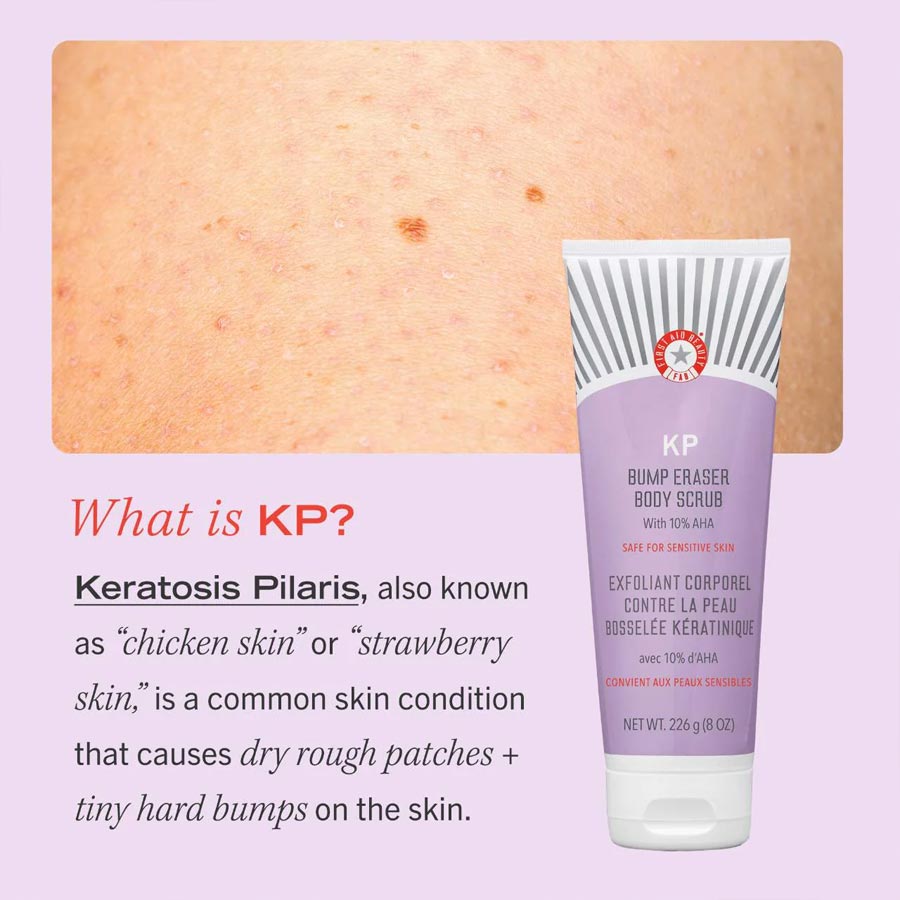 First Aid Beauty KP Bump Eraser Body Scrub with 10% AHA Body Exfoliant