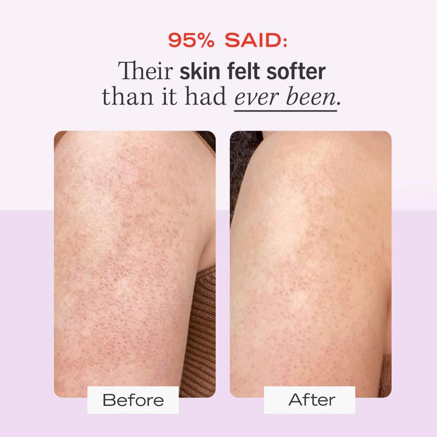 First Aid Beauty KP Bump Eraser Body Scrub with 10% AHA Body Exfoliant