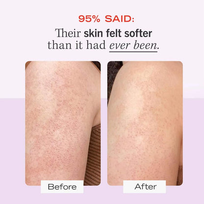 First Aid Beauty KP Bump Eraser Body Scrub with 10% AHA Body Exfoliant