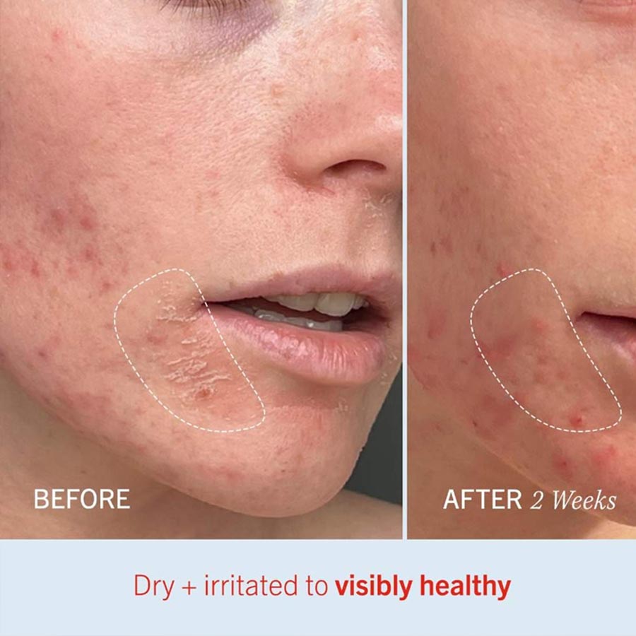 First Aid Beauty Ultra Repair Cream Intense Hydration Face and Body Moisturizer for Skin Repair 170g